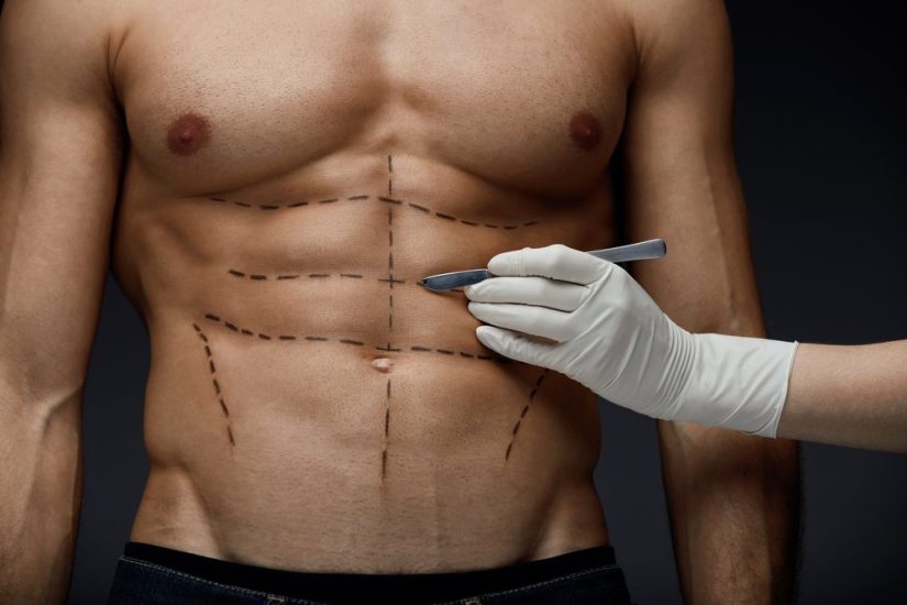 Male Liposuction Recovery: Tips for Fast Recovery