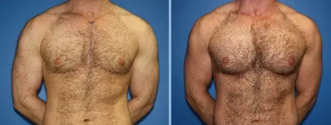 Chest implants for men ,