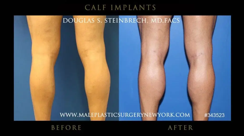 Before and after photos of calf Implants for men