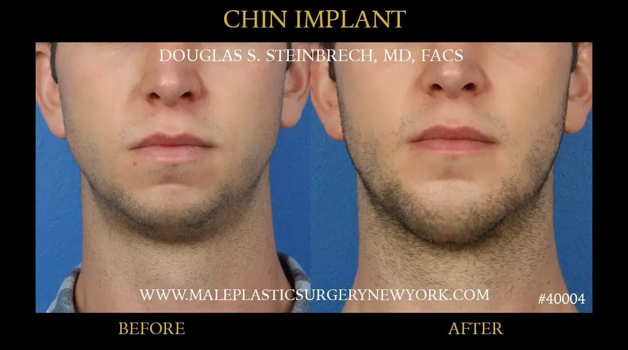 Chin implants for men in NYC 