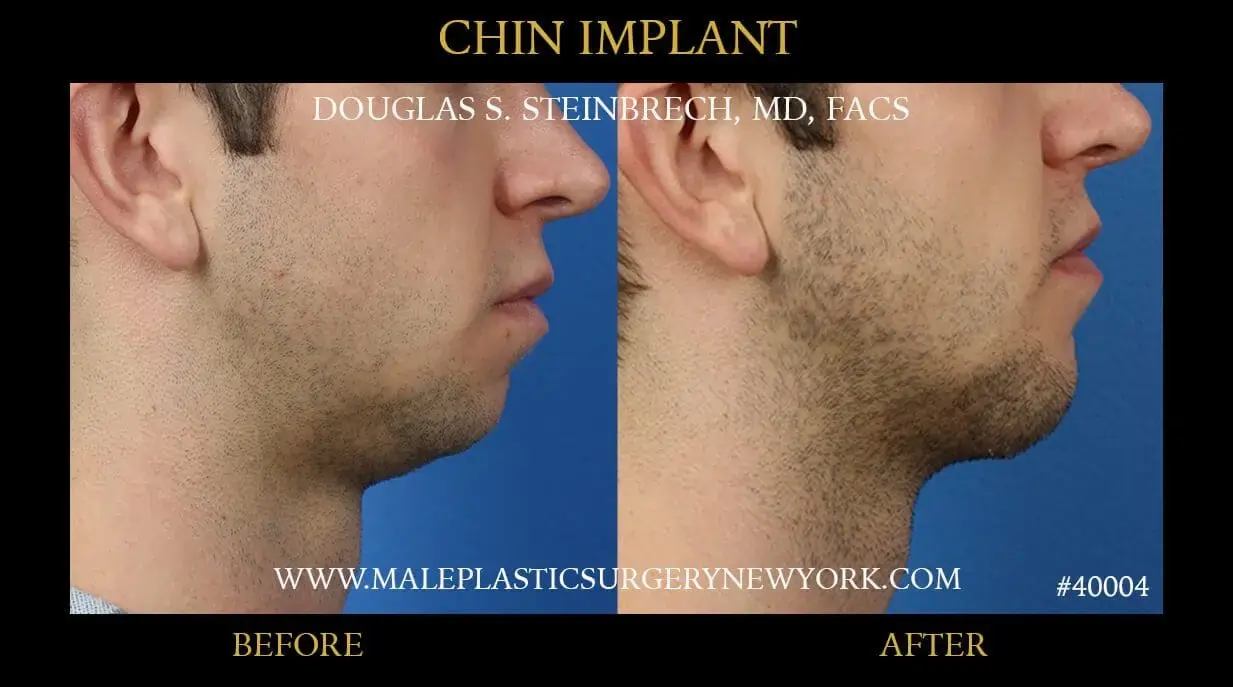 Chin implants surgery for men in NYC  at Male Plastic Surgery New York 