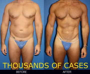 Before and after plastic surgery for men