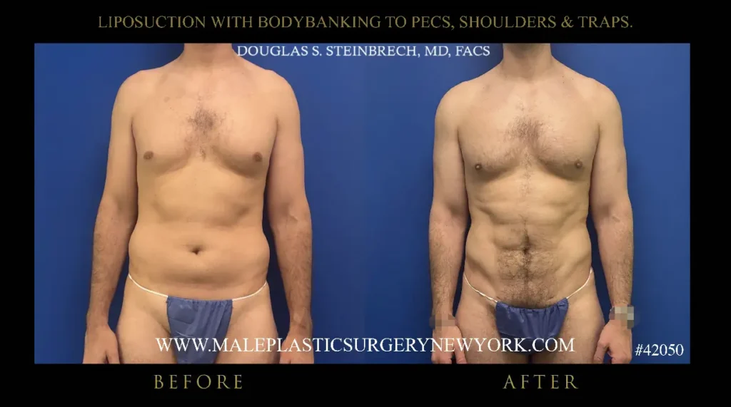 1-lipo-bodybanking-to-pecs-shoulders-traps-anterior-view-nyc