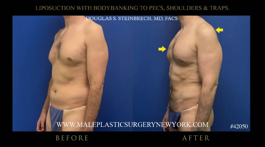 2-lipo-bodybanking-to-pecs-shoulders-traps-45-angle-nyc