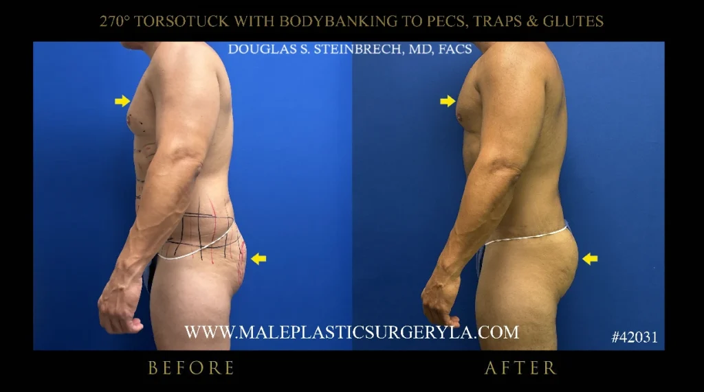 270-degree-torsotuck-nyc-before-after-side-profile