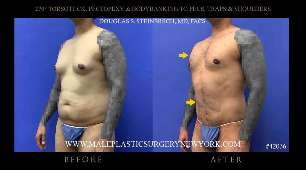 270torsotuck-pectopexy-bodybanking-45degree-left-ny