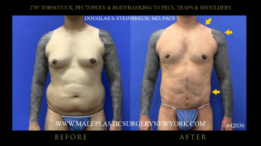 270torsotuck-pectopexy-bodybanking-before-after-ny