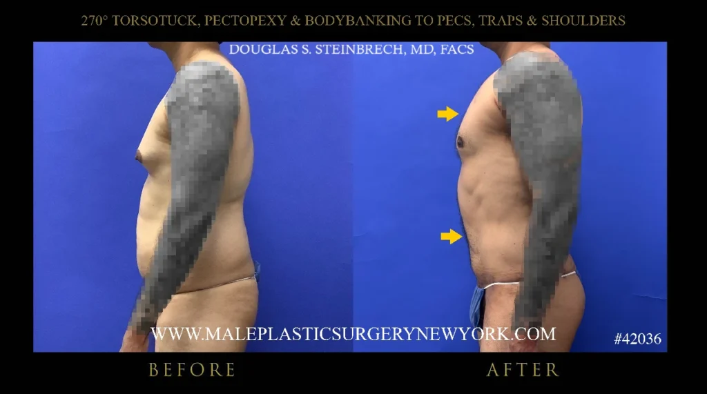 270torsotuck-pectopexy-bodybanking-side-profile-ny