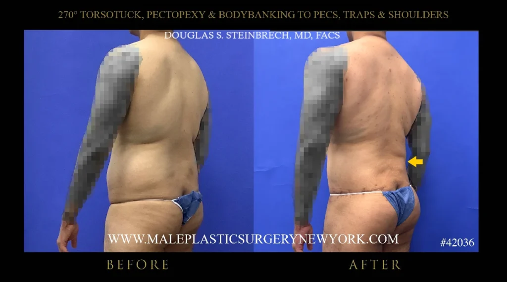 270torsotuck-pectopexy-glutes-45degree-view-ny