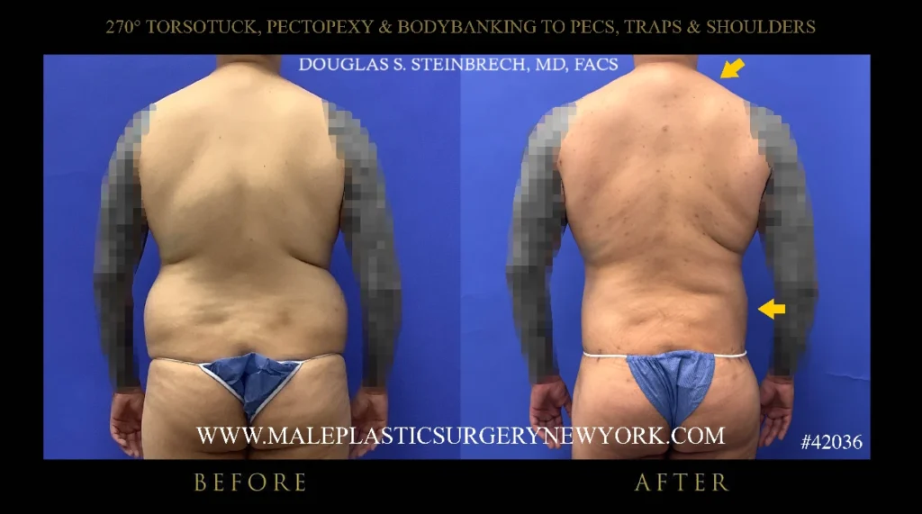 270torsotuck-pectopexy-glutes-straight-on-ny