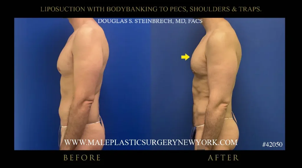 3-lipo-bodybanking-to-pecs-shoulders-traps-left-side-nyc