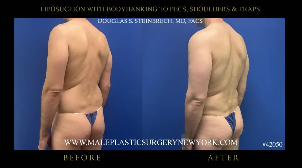 4-lipo-bodybanking-to-pecs-shoulders-traps-135-angle-nyc