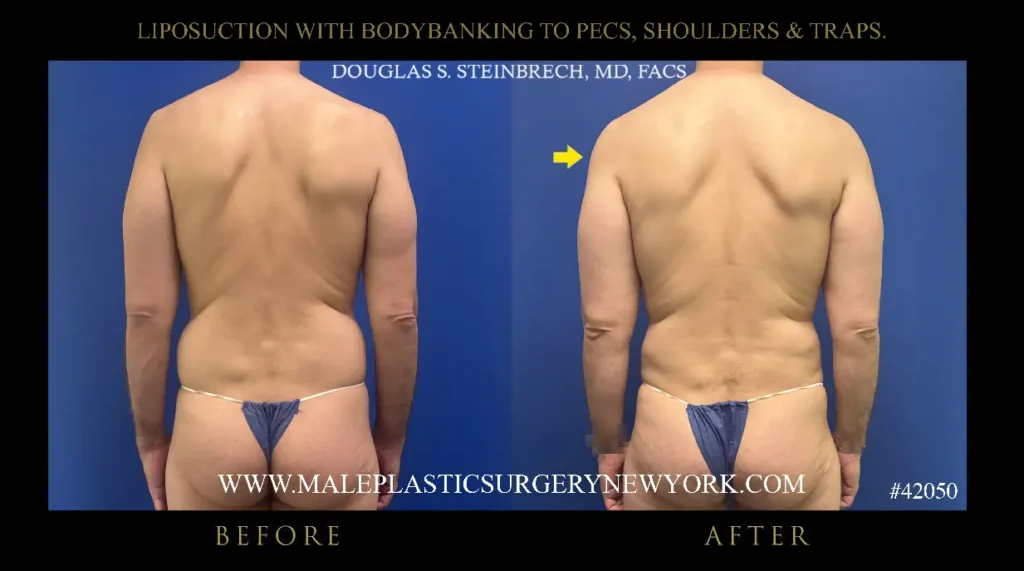 5-lipo-bodybanking-to-pecs-shoulders-traps-posterior-view-nyc