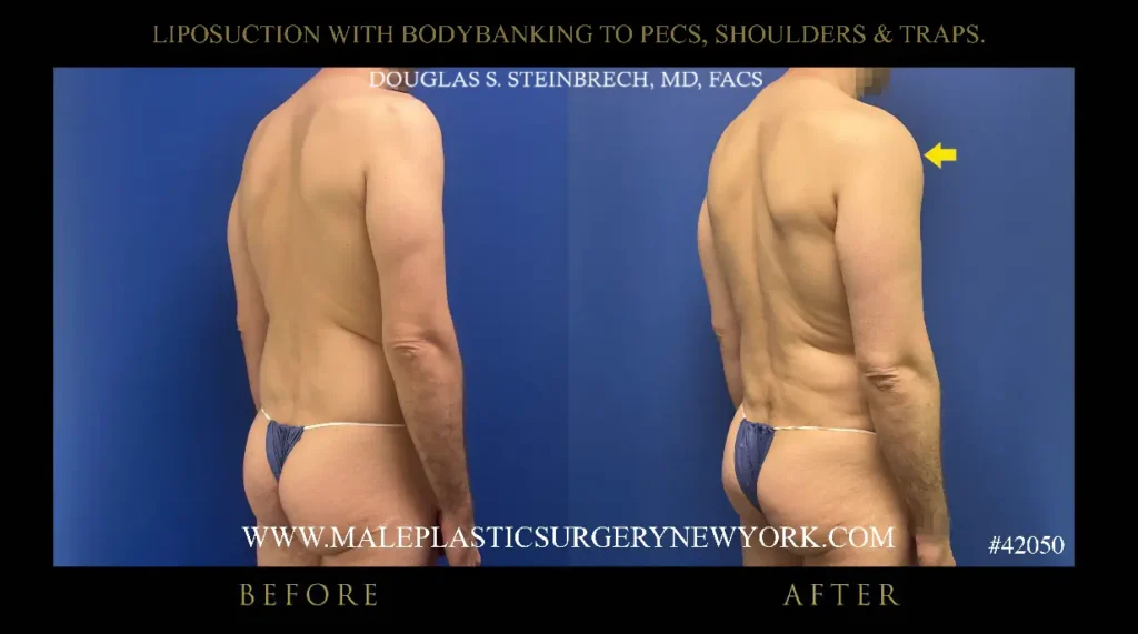 6-lipo-bodybanking-to-pecs-shoulders-traps-225-angle-nyc