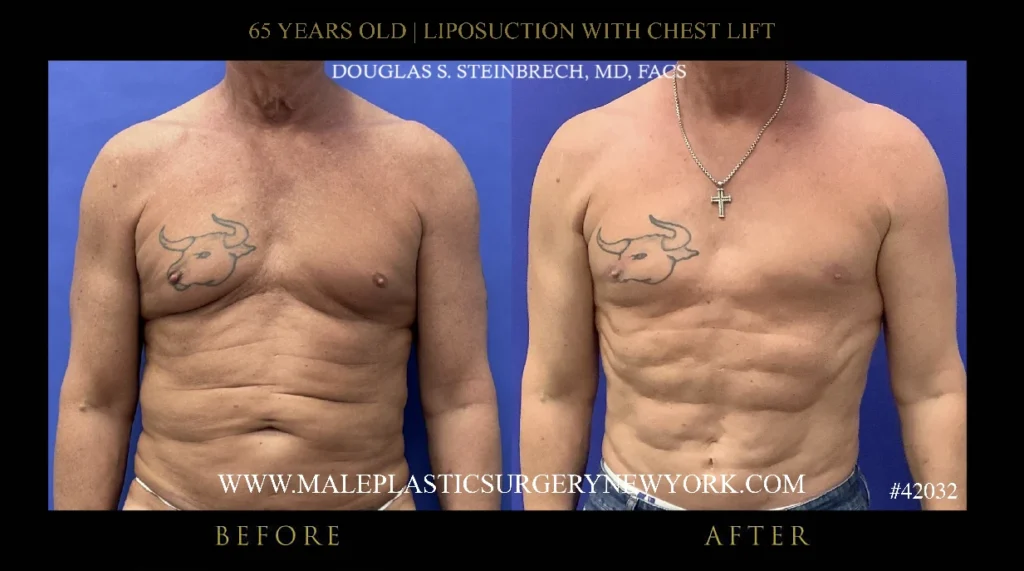 65yo-male-lipo-chestlift-before-after-ny