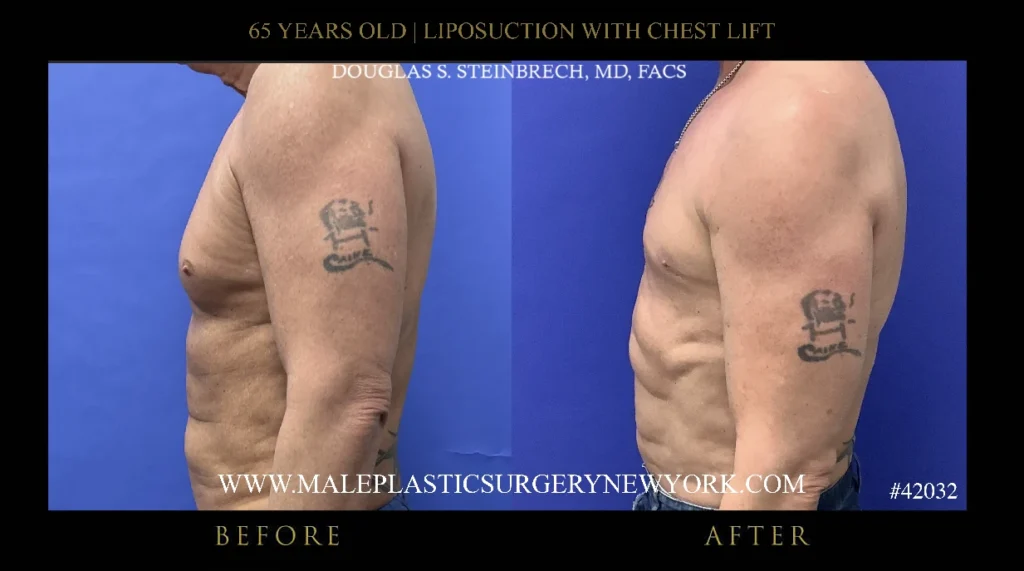 65yo-male-lipo-chestlift-left-side-ny