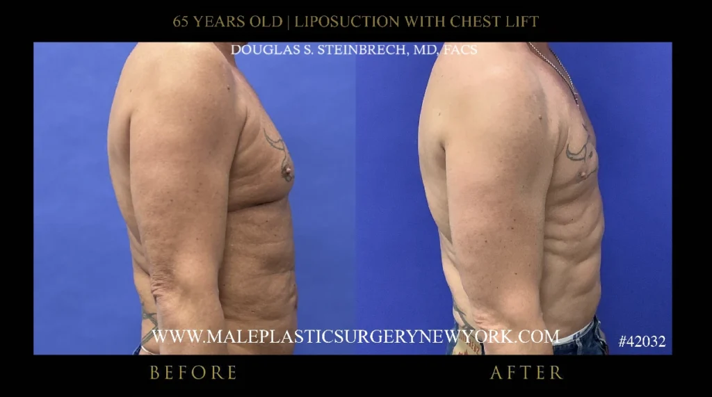 65yo-male-lipo-chestlift-right-side-ny