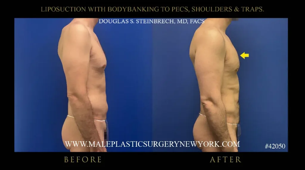 7-lipo-bodybanking-to-pecs-shoulders-traps-right-side-nyc
