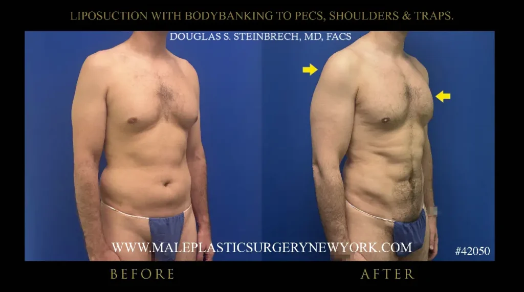8-lipo-bodybanking-to-pecs-shoulders-traps-315-angle-nyc