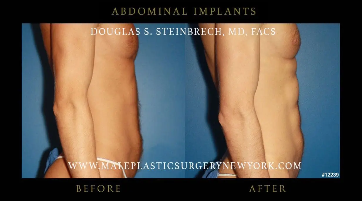 ab implants cost in nyc