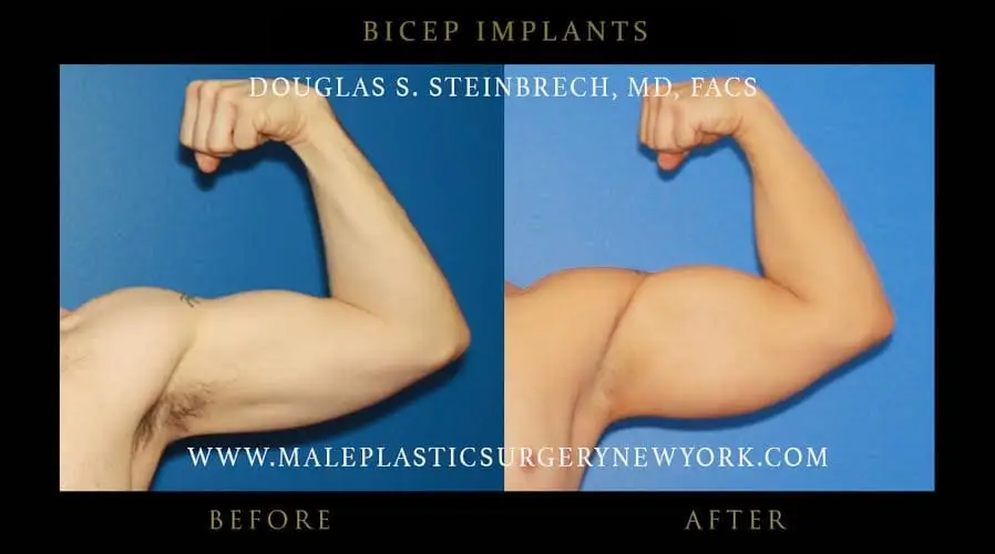 bicep implants