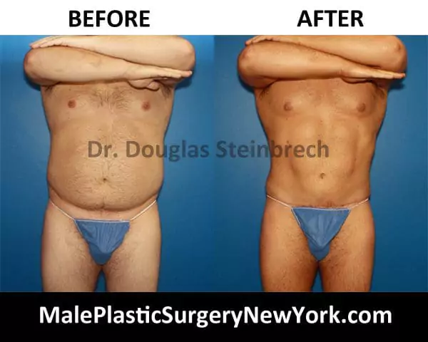 Weight Loss Plastic Surgery Before & After Photos