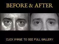 Upper & Lower Eyelift Surgery - Before & After