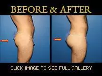 Gluteal Enhancement - Before & After
