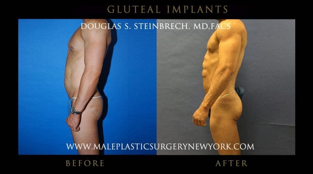 Buttock Implants - Before & After