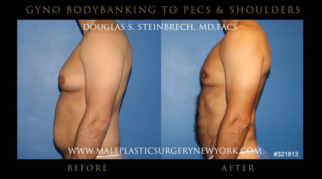 Gynecomastia - Before and After