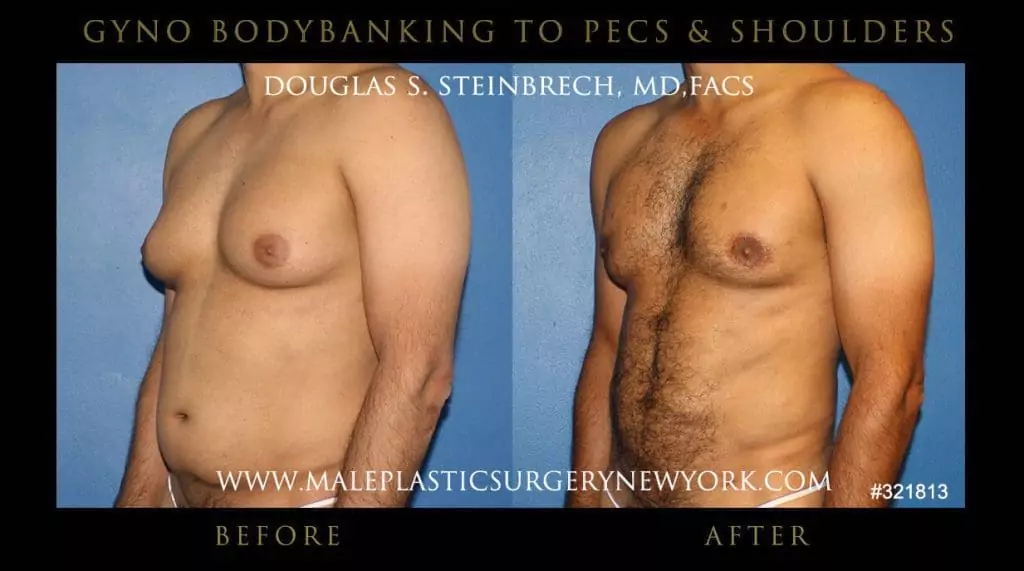 Gynecomastia - Before and After