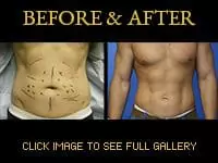 Liposculpting - Before & After
