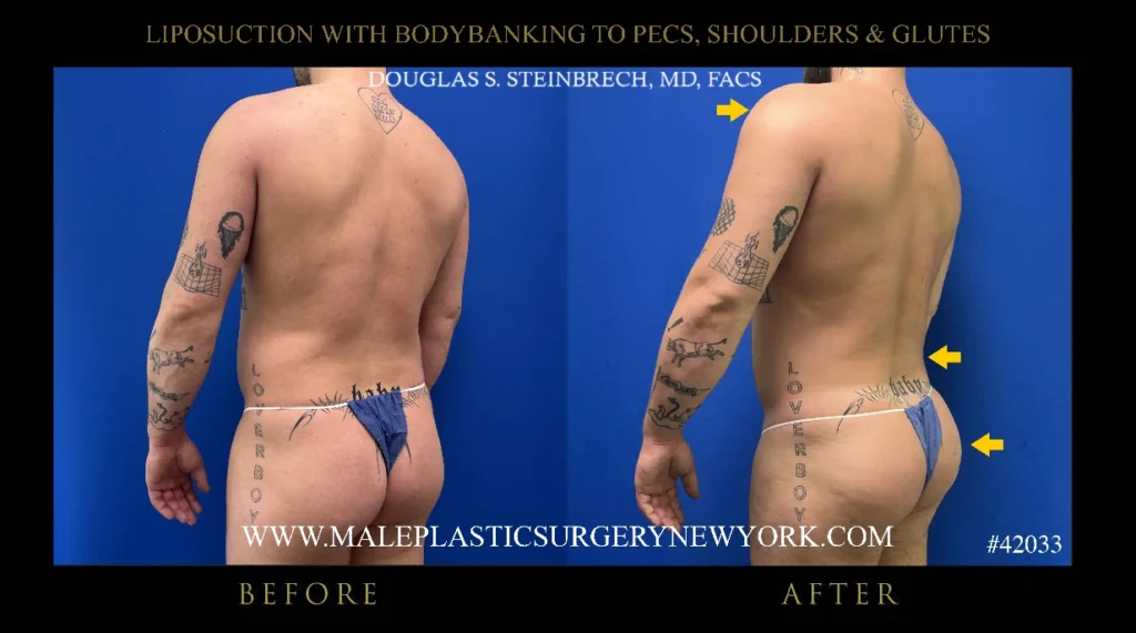 lipo-bodybanking-glutes-45degree-view-ny