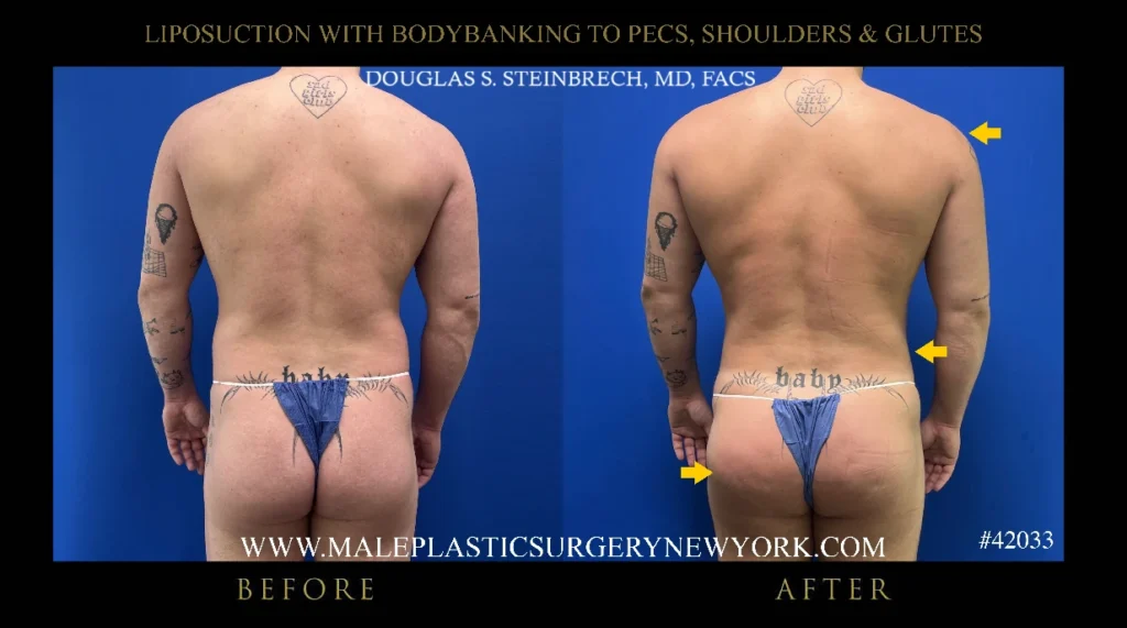 lipo-bodybanking-glutes-straight-on-ny