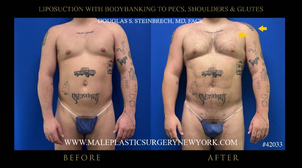 lipo-bodybanking-pecs-shoulders-glutes-before-after-ny