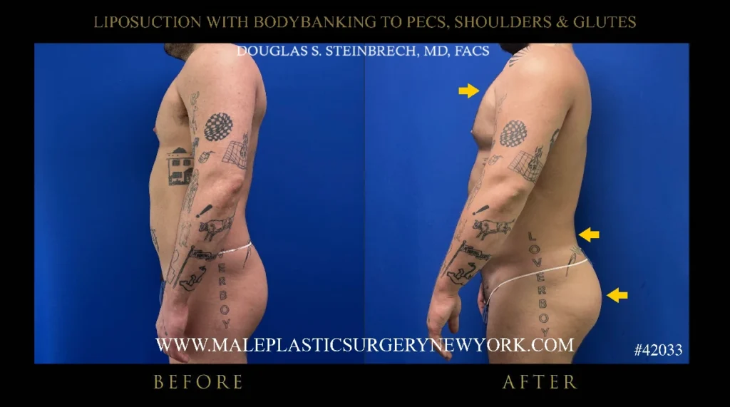 lipo-bodybanking-pecs-shoulders-glutes-side-profile-ny