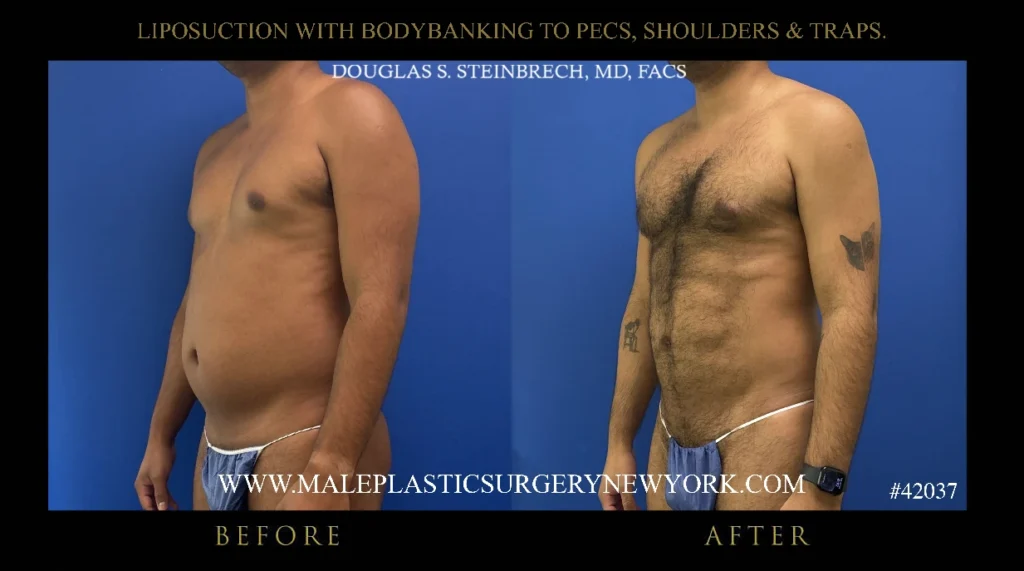 lipo-bodybanking-pecs-shoulders-traps-45degree-left-ny