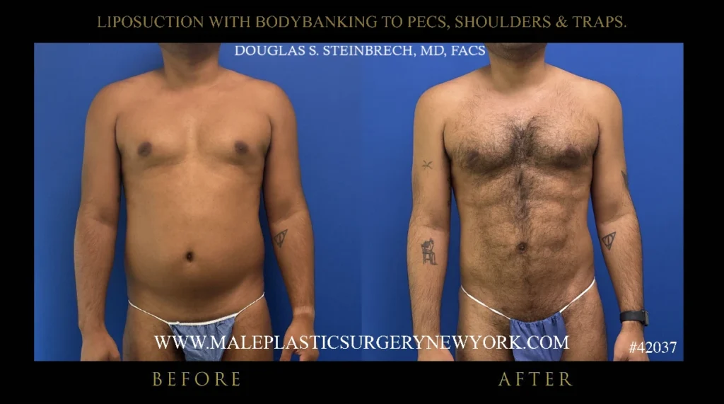 lipo-bodybanking-pecs-shoulders-traps-before-after-ny