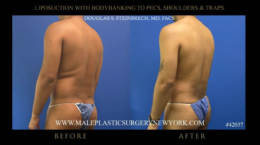 lipo-bodybanking-pecs-shoulders-traps-glutes-45degree-view-ny