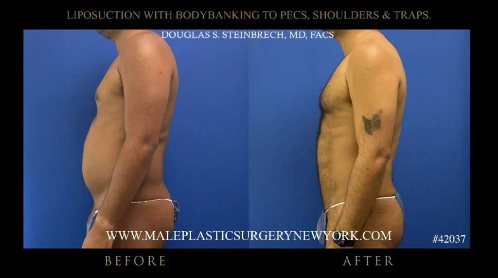 lipo-bodybanking-pecs-shoulders-traps-side-profile-ny