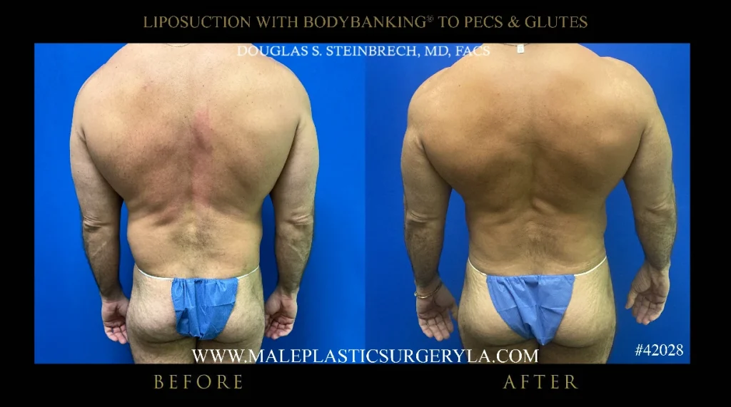 liposuction-bodybanking-nyc-before-after-posterior-view
