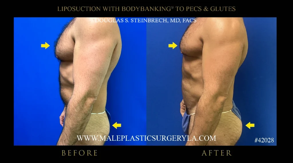 liposuction-pecs-glutes-new-york-left-profile