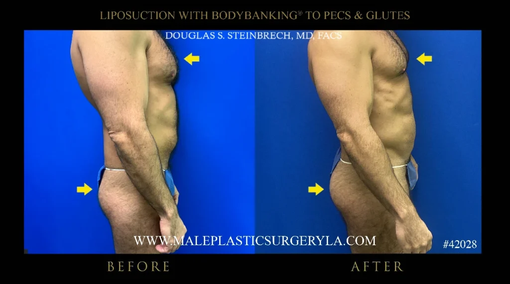 male-lipo-bodybanking-nyc-before-after-right-side