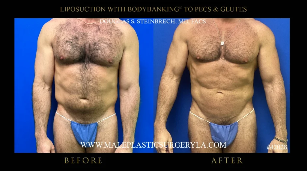 male-liposuction-bodybanking-nyc-before-after-frontal