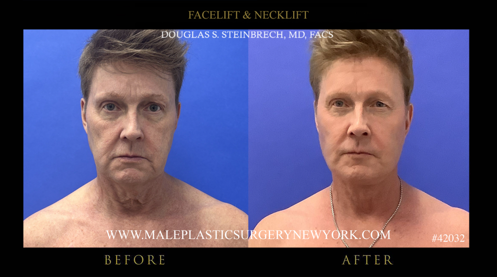 nyc-male-facelift-before-after-2