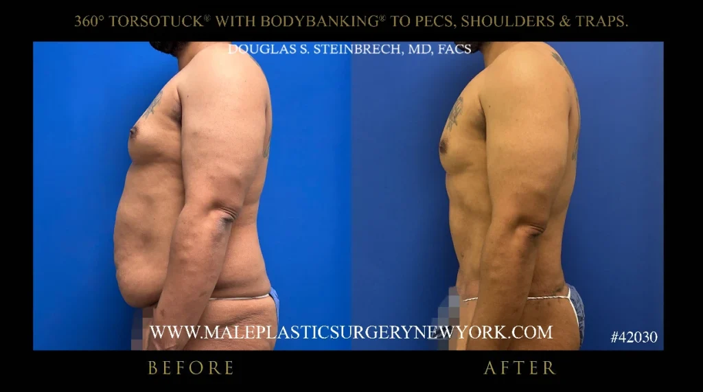 nyc-male-plastic-surgery-side-view-bna