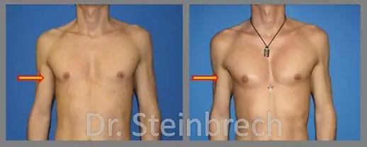 Pec Augmentation - Before and After