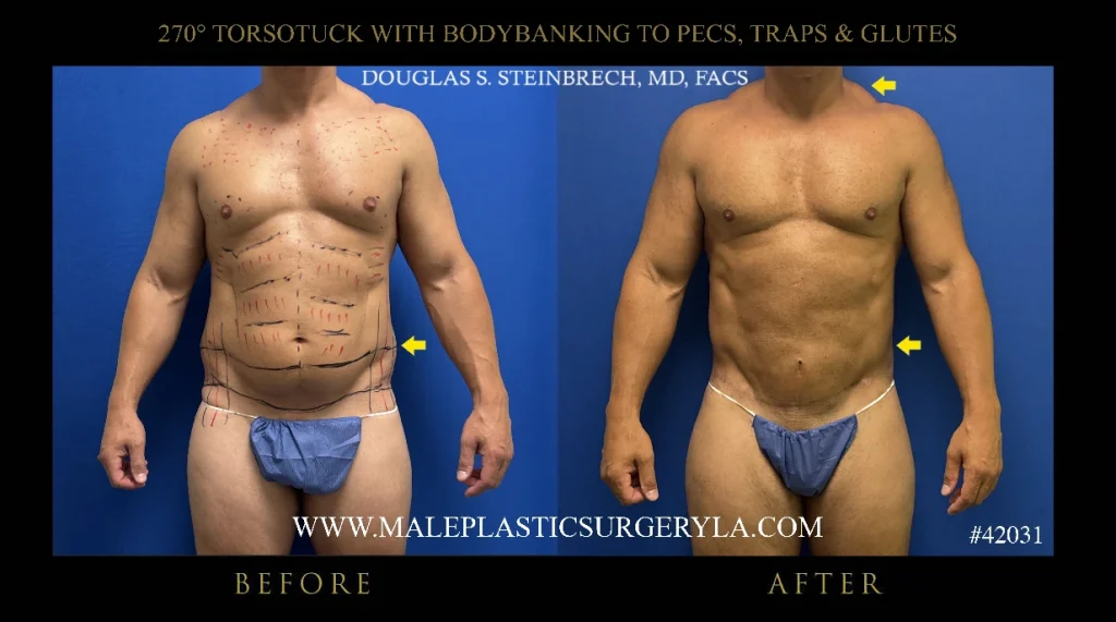 torsotuck-bodybanking-nyc-before-after-frontal