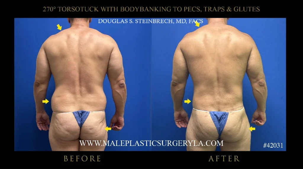 torsotuck-bodybanking-nyc-before-after-posterior