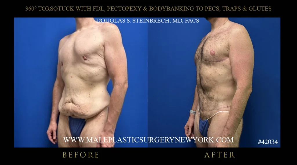 torsotuck-fdl-pectopexy-bodybanking-45degree-left-ny
